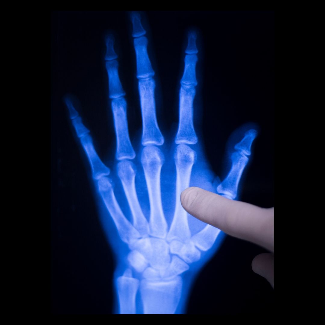 Workers Comp Hand Injury in Suffolk County